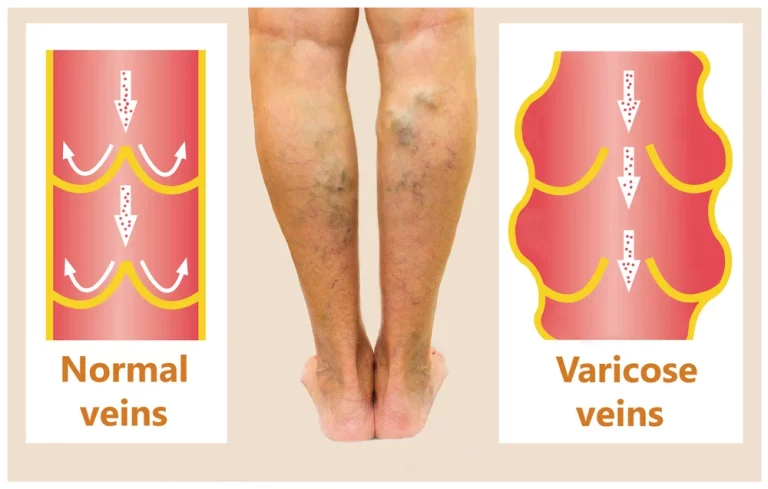 Varicose