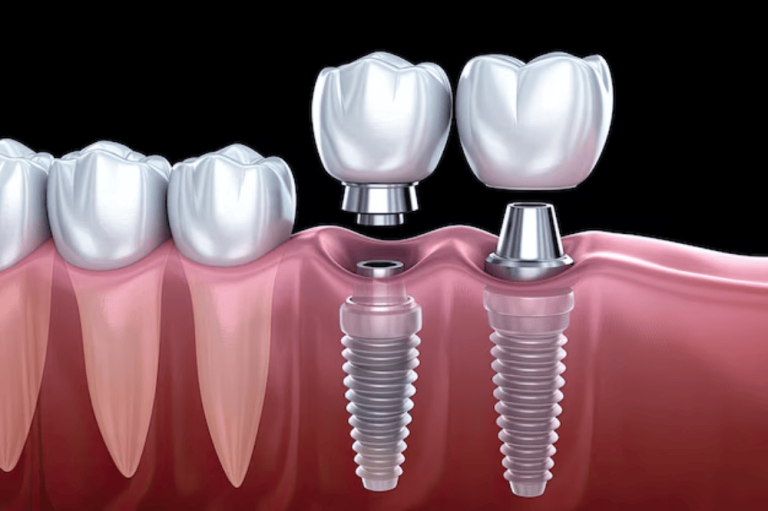 implantteeth